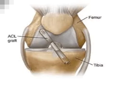 Knee Ligament in pcmc