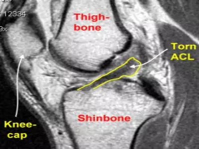 Knee Ligament in pune