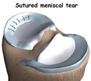 Meniscus Tear Treatment