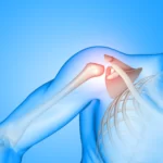 total hip arthroplasty in kharadi