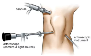 arthroknee in pcmc