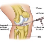 arthroscopic-meniscus-repair-surgery