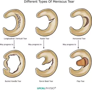 Meniscus Tear Treatment