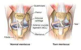 Meniscus Tear Treatment